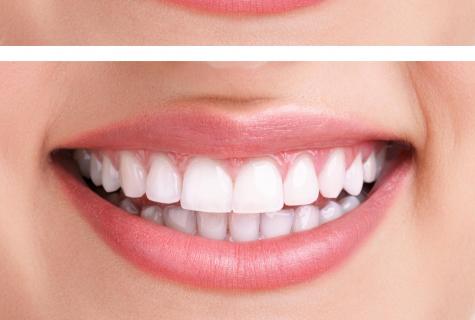 Whether bleaching of teeth is harmful?