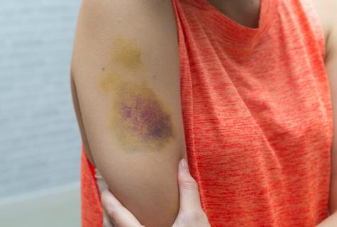 What to do at a bruise?