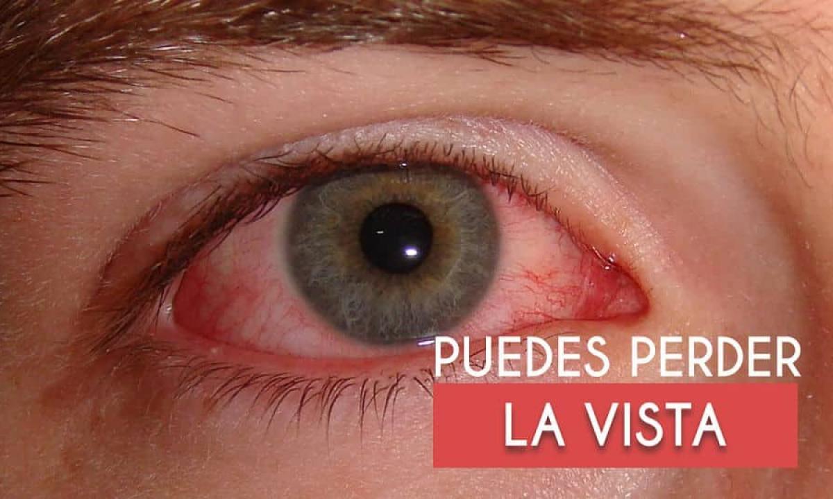 Syndrome of a dry eye - symptoms