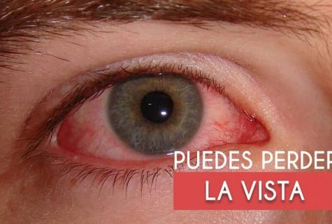 Syndrome of a dry eye - symptoms