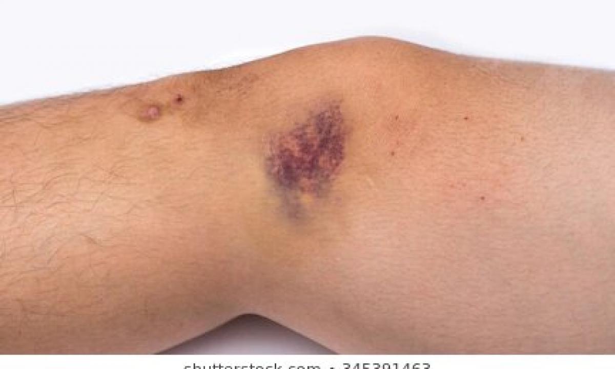 What to do at a severe bruise of a leg?