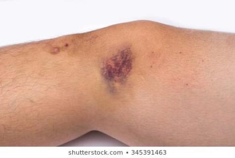 What to do at a severe bruise of a leg?