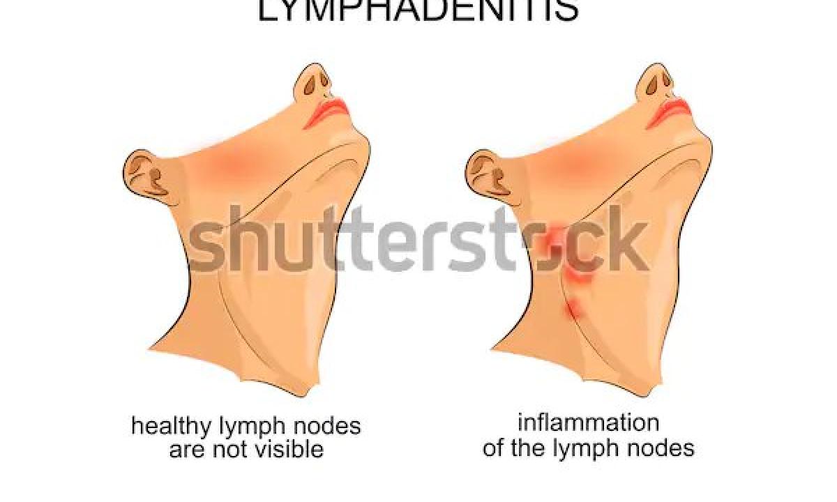 What to do if the lymph node inflamed?