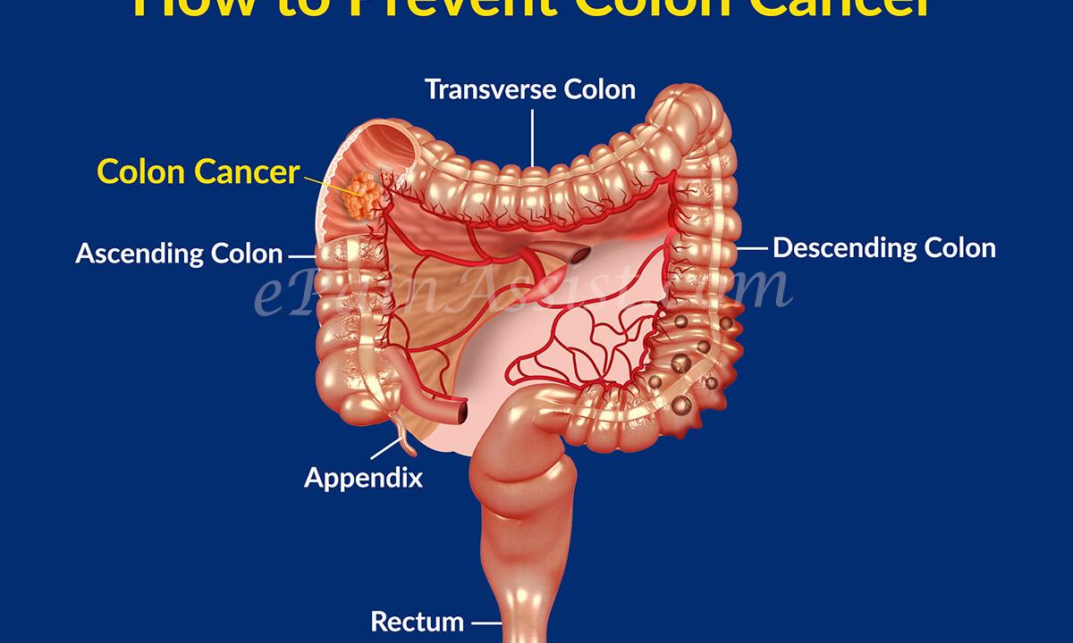 How to prevent cancer?