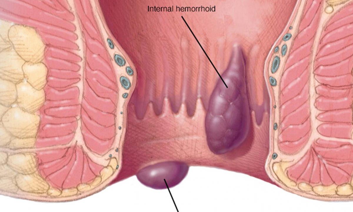 Medical technique of Kegel at hemorrhoids: as it is correct to carry out exercises"