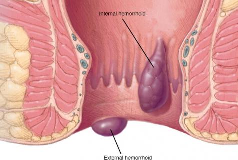 Medical technique of Kegel at hemorrhoids: as it is correct to carry out exercises