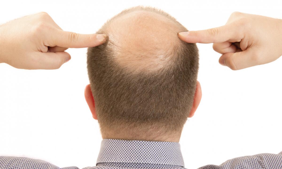How to get rid of baldness?
