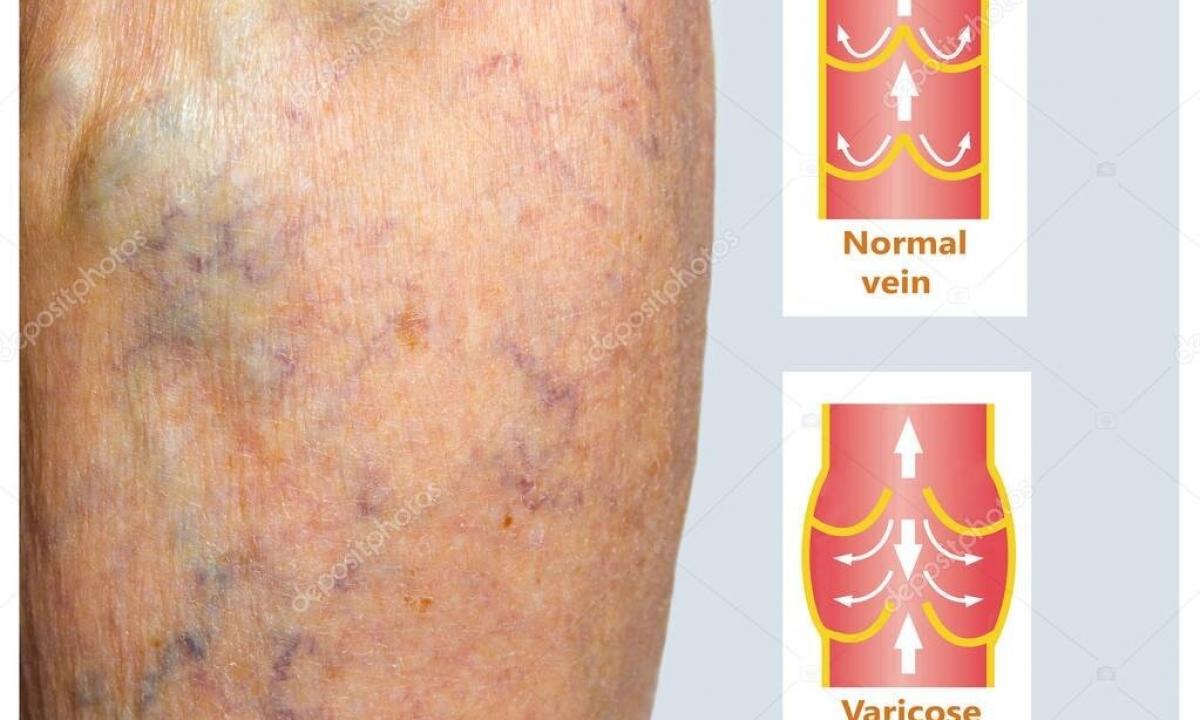 Early diagnosis of varicose veins of the lower extremities