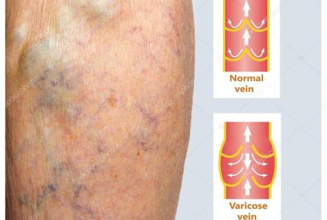 Early diagnosis of varicose veins of the lower extremities