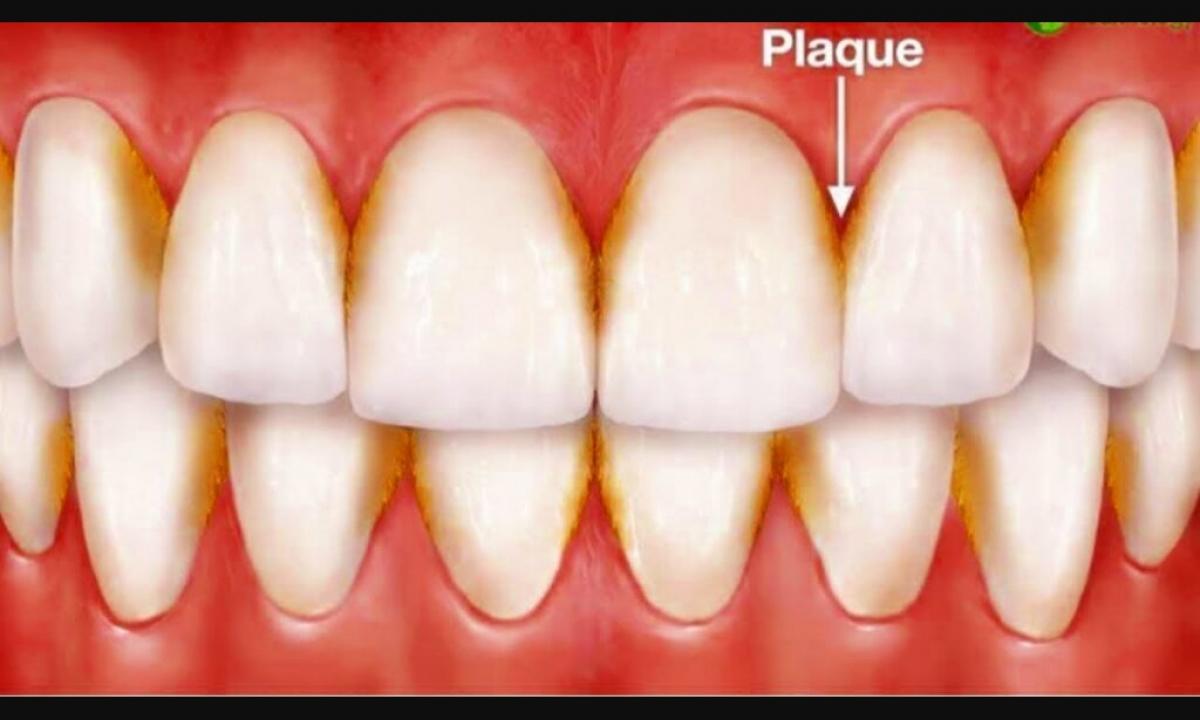 How to clean a dental plaque?