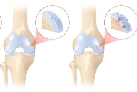 Indications to replacement of a knee joint