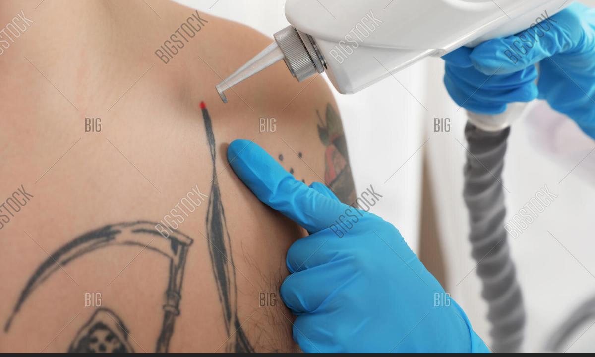 As there is removal of tattoo the laser