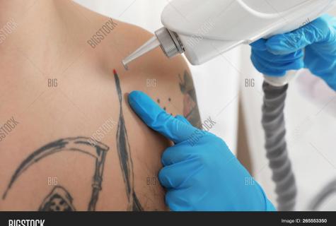 As there is removal of tattoo the laser