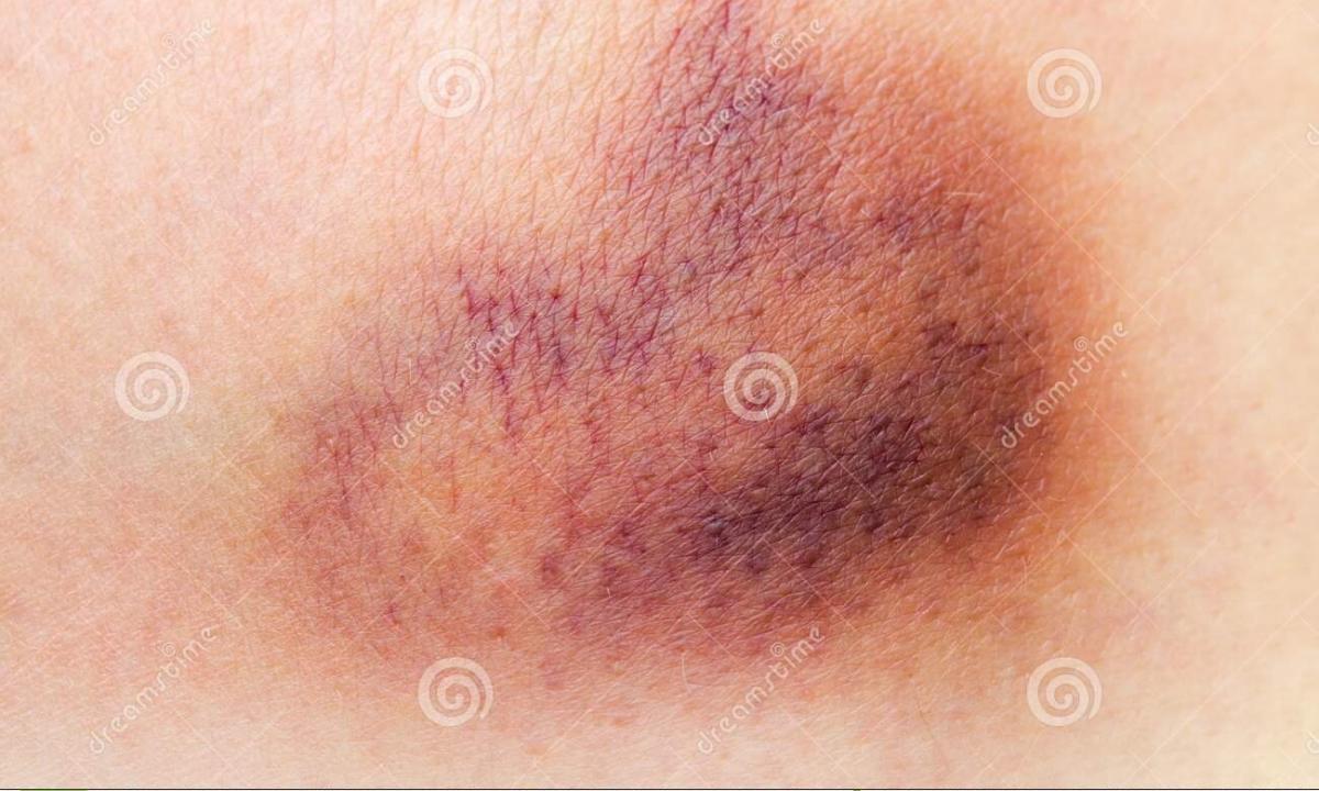 How quickly to remove bruise on face