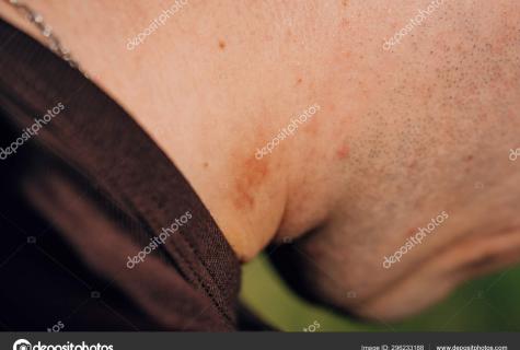 How quickly to remove hickey on neck