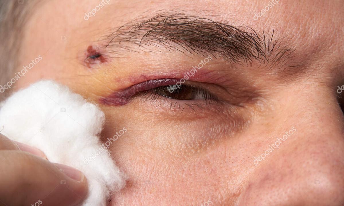 How to remove bruise eye