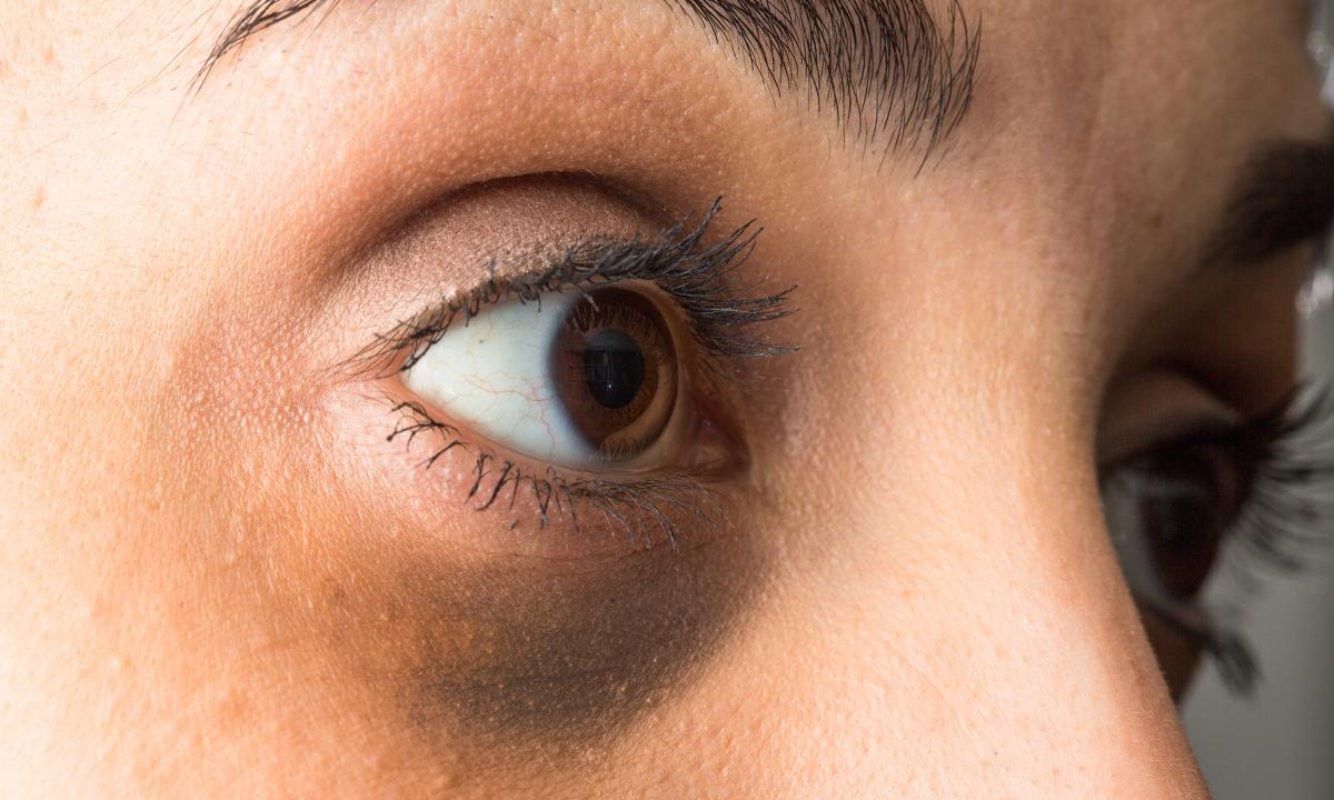 How to reduce black eye