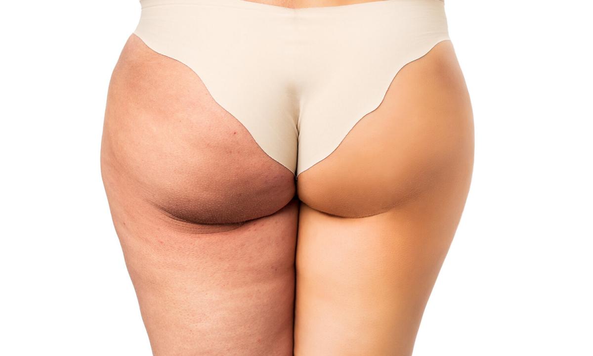How to get rid of cellulitis on hips and buttocks