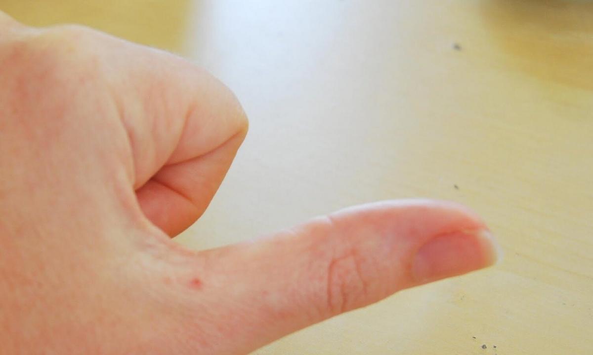 How to get rid of hand wart