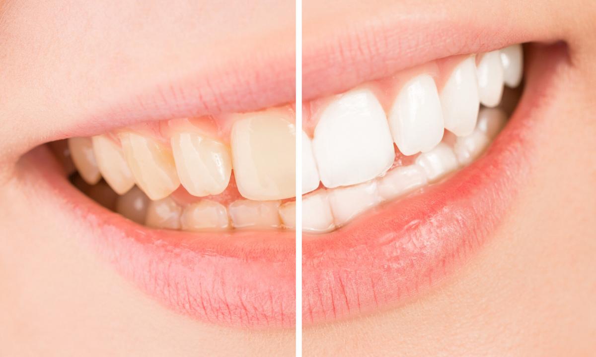 How to bleach teeth hydrogen peroxide