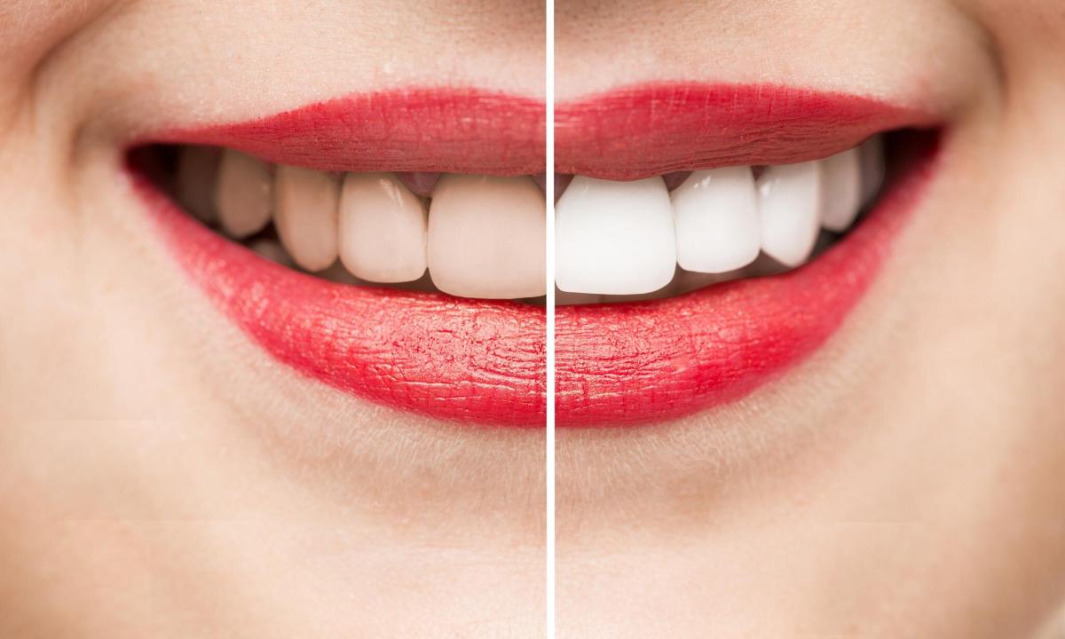 How to achieve snow-white smile