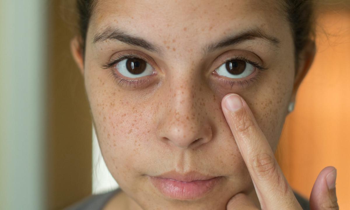 How to overcome dark circles under eyes