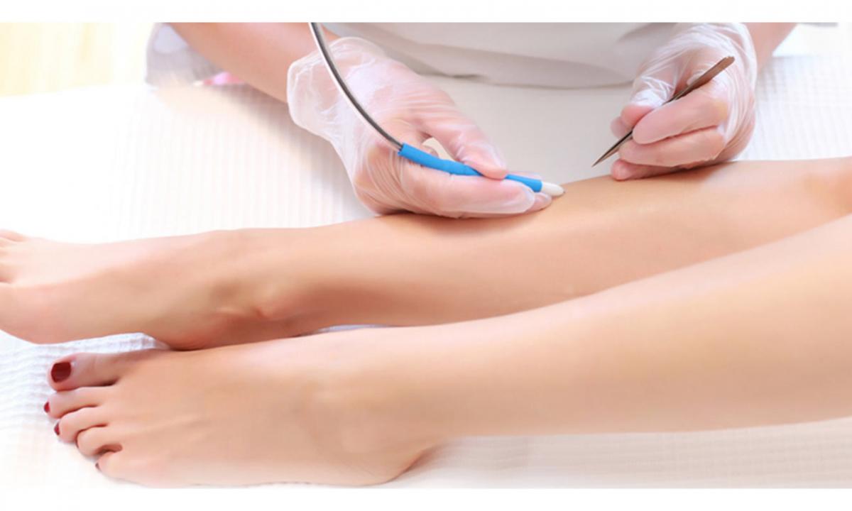 How to be prepared for electroepilation