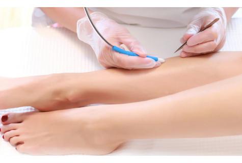 How to be prepared for electroepilation