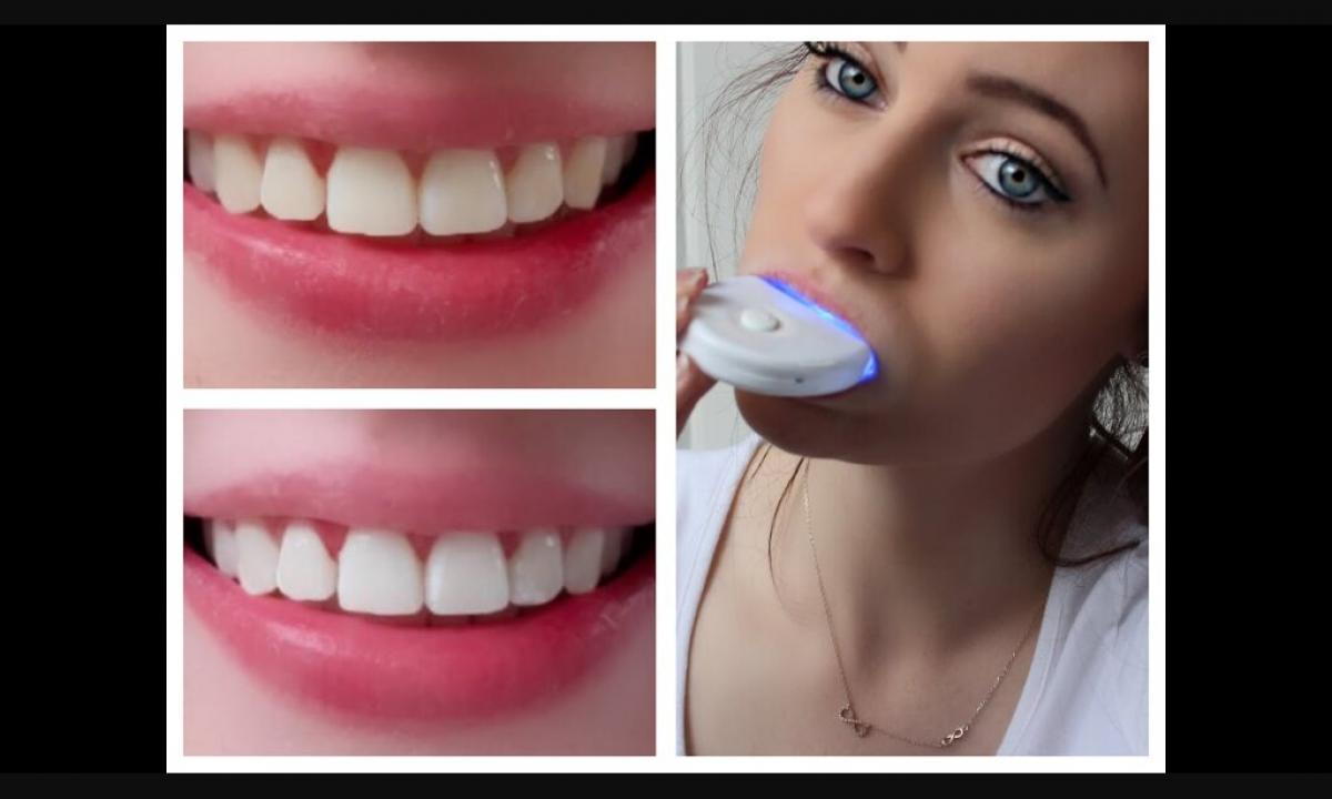 How to bleach teeth it is safe: useful information