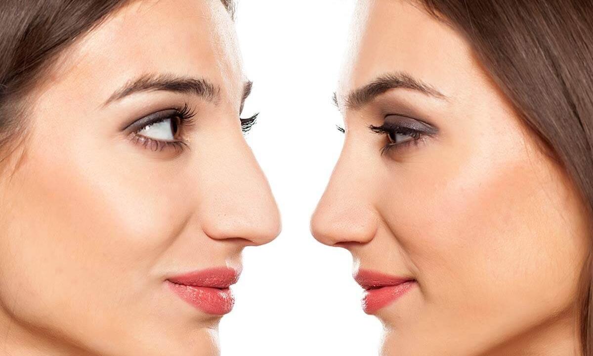 How to correct nose