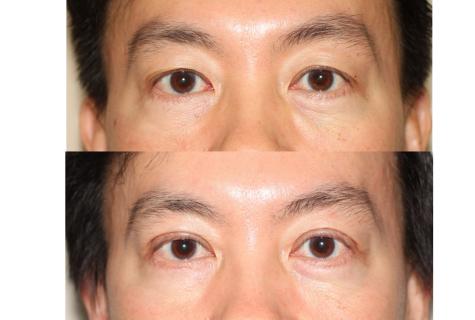 How to bring lower eyelid