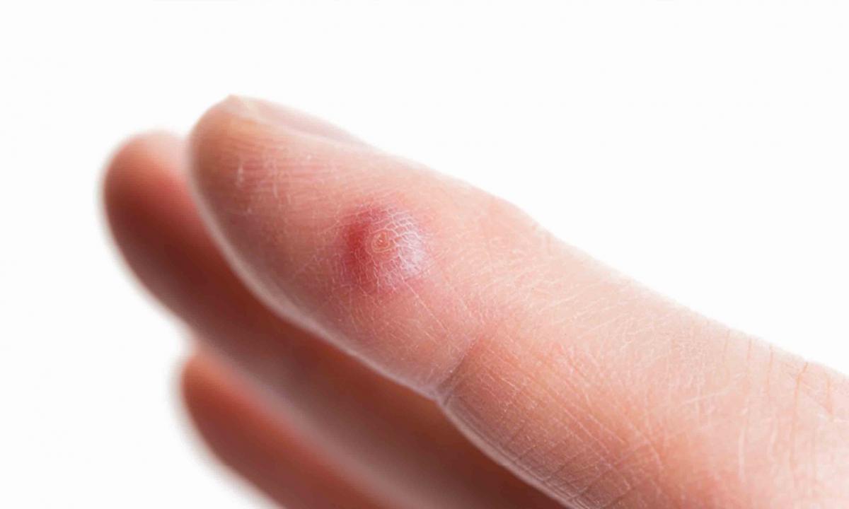 How to remove finger warts