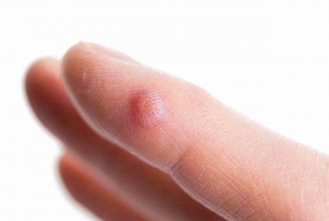 How to remove finger warts