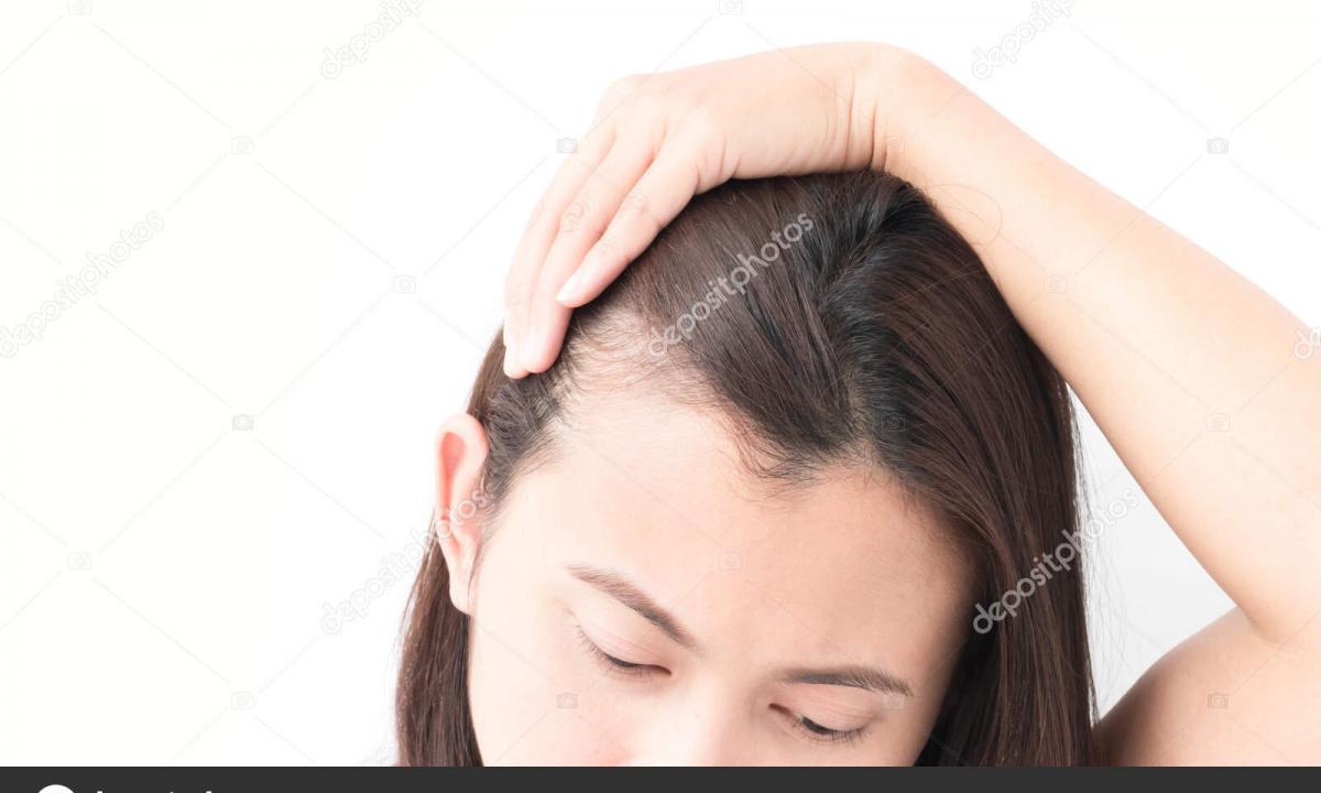 How to treat baldness at women