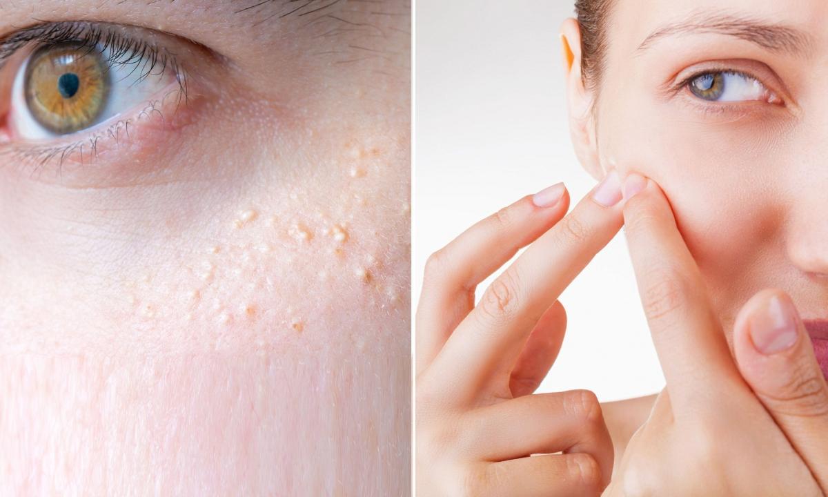 How to remove pimples on hands