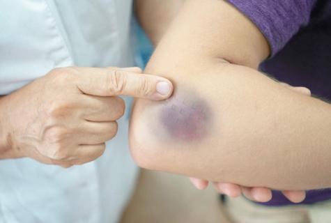 How to remove bruise