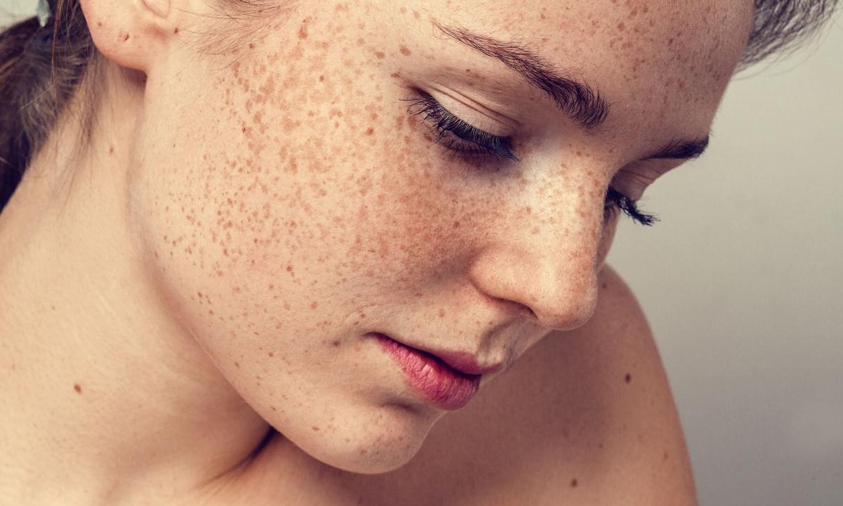 How to remove spots on body