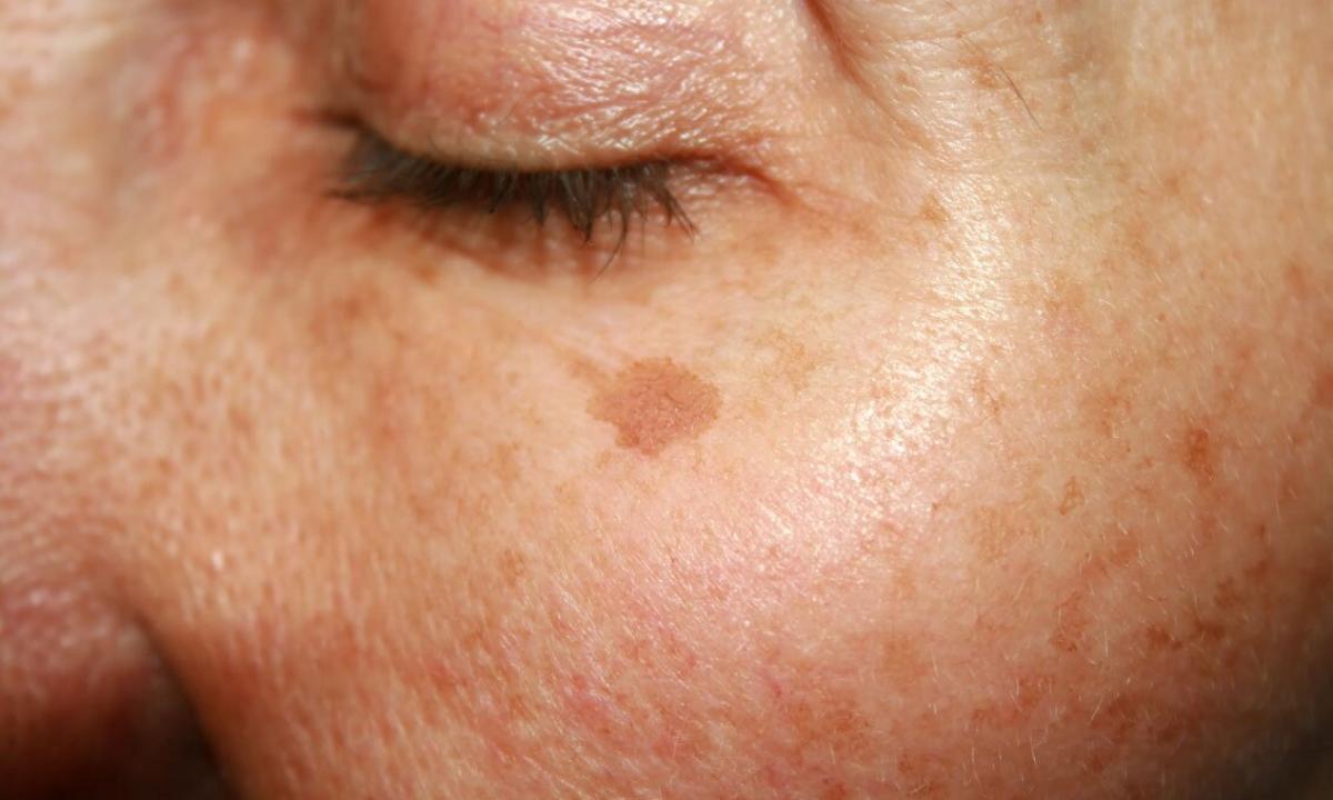 How to get rid of pigmental spots