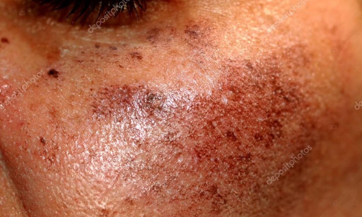 How to remove pigmental spots