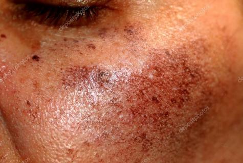How to remove pigmental spots