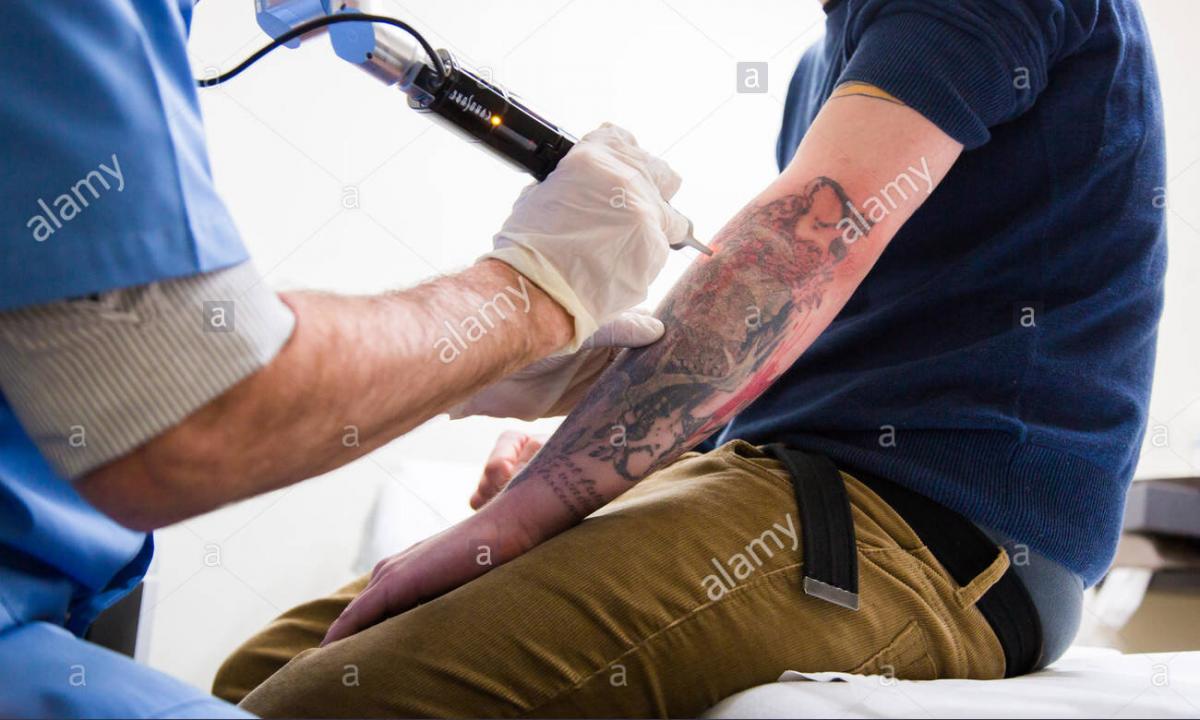 How to remove tattoo