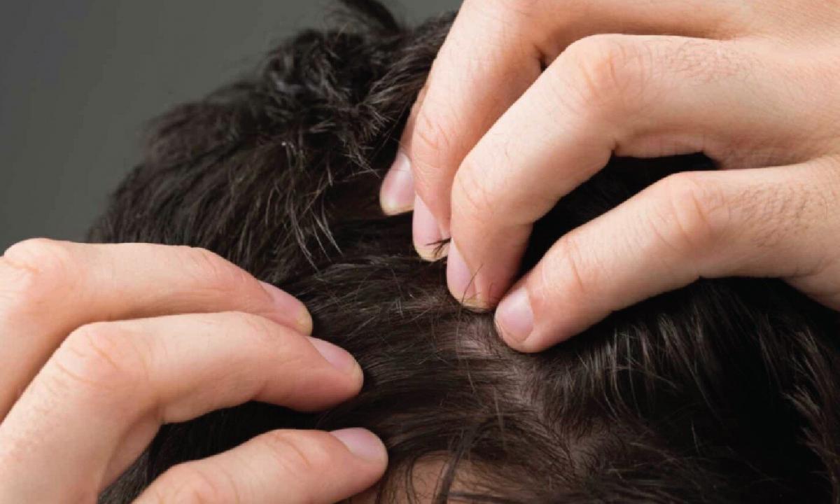 Causes of hair loss and their decision