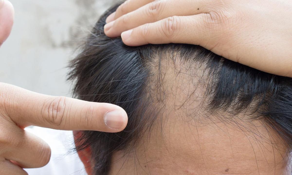 Folk remedies from hair loss