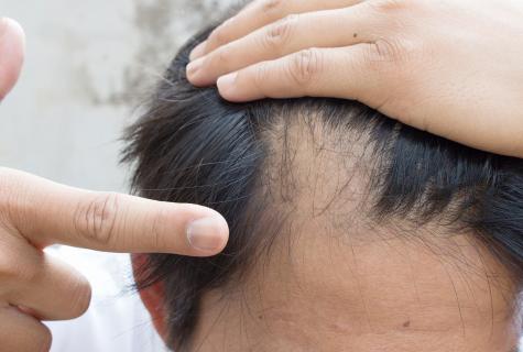 Folk remedies from hair loss
