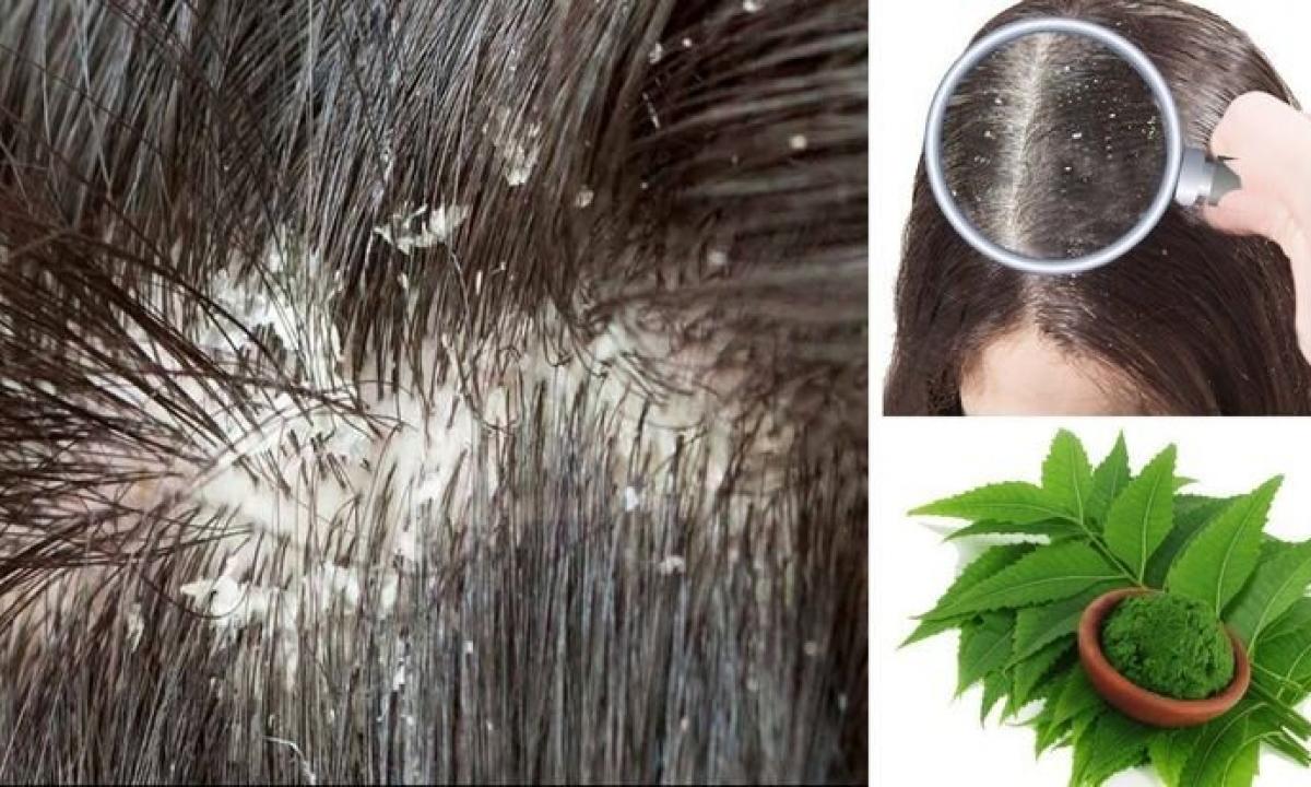 How quickly to get rid of dandruff folk remedies