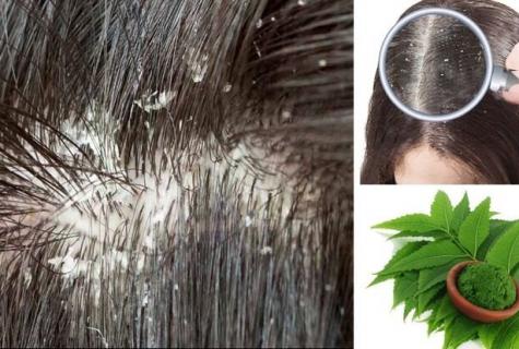 How to get rid of dandruff, national recipes