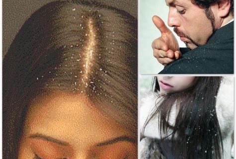 Dandruff: reasons of emergence and methods of fight