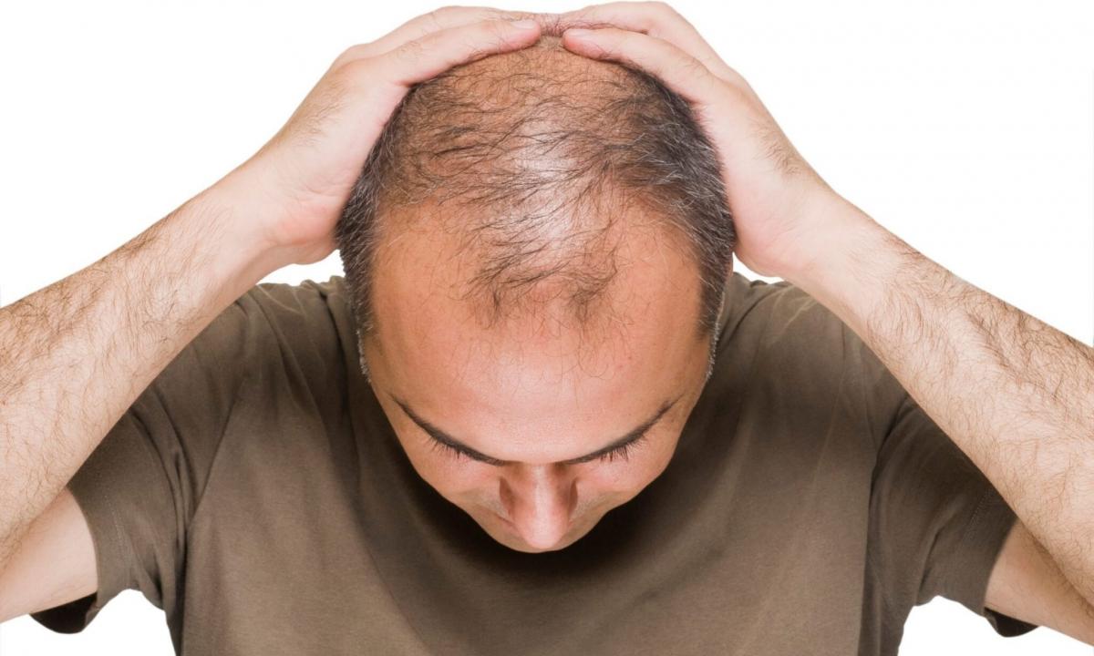 What to do if baldness begins
