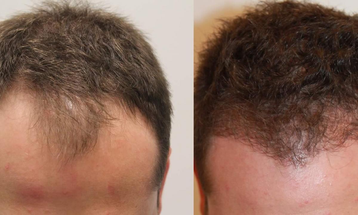 How to restore density of hair