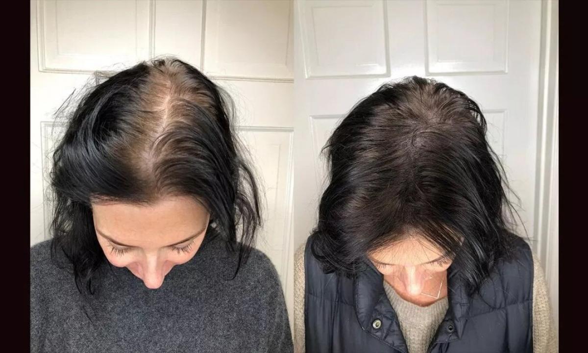 How to recover hair after loss